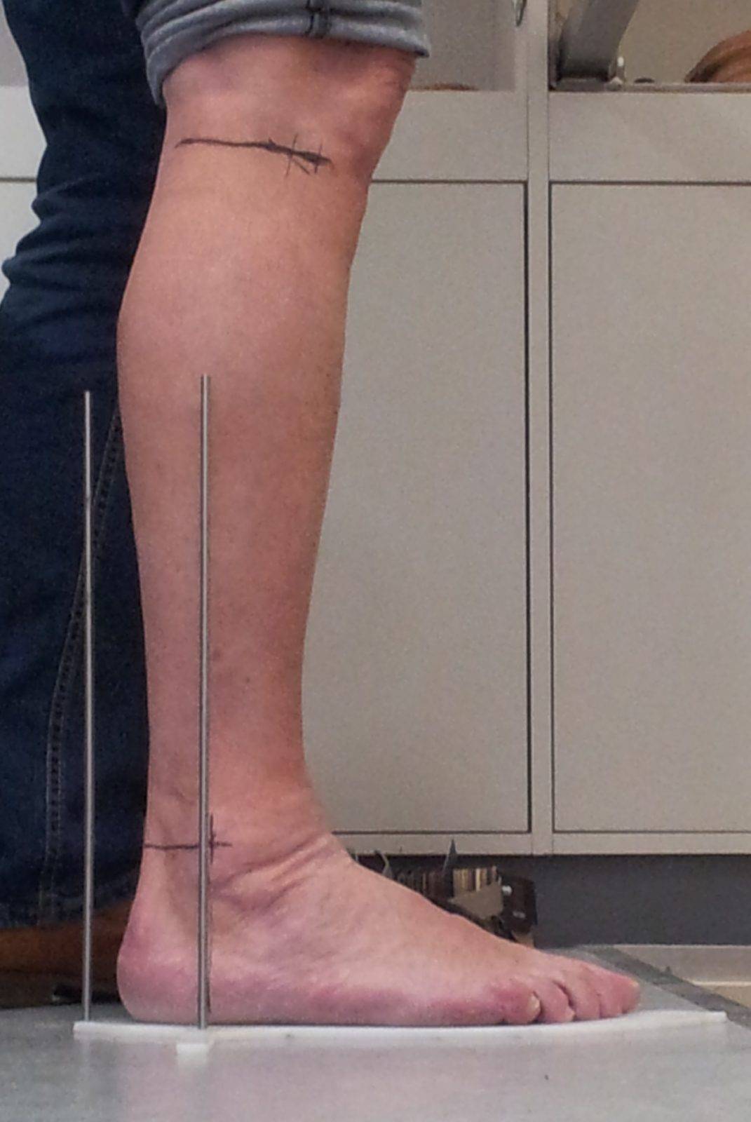 Dynamic Ankle Foot Orthosis • Ambroise